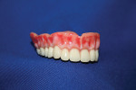 Figure 8. Finished temporary denture.