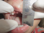 Figure 16 Postoperative photograph showing improvement in mouth opening after treatment (Case 6).