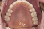 Figure 13 Maxillary arch showing the final restorations. The anatomy on the posterior teeth showed that the equilibration was completed without flattening the occlusal surfaces; it instead enhanced the cusps.