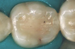 Figure 3  The existing restoration displayedstaining, marginal gaps, and recurrent caries.