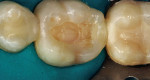 Figure 4  The finished preparation required significantpulpal extension to remove the caries. Theremaining tooth structure was hard but discolored.
