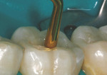 Figure 6  The shade 02 composite material wasplaced in 2-mm increments up to within 1.5 mmof the final occlusal surface and cured.
