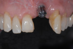 Figure 5 Removal of the restoration further reveals improper implant position from mesial, buccal, lingual, coronal, and angulation perspectives.