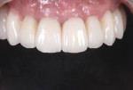 Figure 15 Pretreatment and post-treatment views of the implant-supported reconstruction. Notice the favorable changes in the gingival outline and tooth proportions.