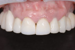Figure 14 Pretreatment and post-treatment views of the implant-supported reconstruction. Notice the favorable changes in the gingival outline and tooth proportions.