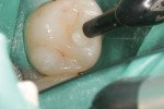 Figure 6 Filtek Bulk Fill posterior restorative being injected into the tooth in a single 4-mm increment.