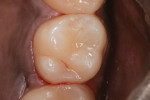 Figure 10 Patient shown after rubber dam removal with the finished restoration.