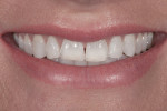 Figure 1 The full-smile pretreatment photograph demonstrated the deficient incisor length due to wear.