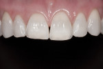 Figure 4 Note the chipped and translucent incisal edges of the centrals and laterals.