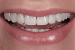 Figure 12 A full smile revealed incisors’ length that was no longer deficient.