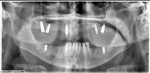 Figure 4 Panoramic radiograph representing a patient that was likely restored using an adaptive approach rather than a reconstructive approach. Note the different implant systems used, the differing levels of placement apico-occlusally, and the poor angulations. Now that the remaining dentition has failed due to recurrent caries, a treatment planning problem is imminent if the current implants are to be utilized in the final full arch prosthesis.