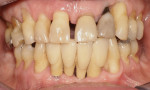 Figure 3 Post-periodontal therapy with final implant supported restorations, Nos. 23 through 26, in place.