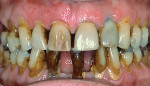 Figure 2 Intraoral photograph revealing poor oral hygiene with significant supragingival calculus accumulation and generalized erythematous gingival margins.