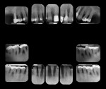 Figure 1 Full-mouth periapical x-rays revealing generalized severe horizontal bone loss in the maxilla and the mandible.