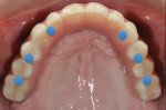Figure 5 Occlusal view of the maxillary implant-supported fixed-detachable hybrid prosthesis. Note the even distribution of the implants made possible through strategic hedging of ideal tooth sites to ensure good anterior-posterior spread and distribution.