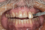 Figure 1 Preoperative view of Subject #1 with a severe tooth discoloration and pre-whitening tooth shades between A3.5 and A4.