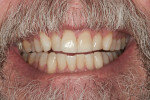 Figure 2 After the in-office and take-home protocol, the patient’s anterior teeth shades
were between B2 and C1 (VC), demonstrating a 9.83-shade improvement.