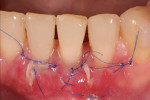 Figure 6. …combined with connective-tissue
grafting.