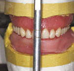 Figure 5a  The orientated existing maxillary dentate.