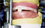 Figure 5b  Tooth orientation with the occlusal matrix.