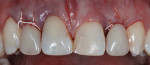 Figure 1 Interim partial denture without tissue contact in surgical sites No. 7 and No. 10. Implant treatment was indicated because of congenitally missing lateral incisors. Teeth No. 8 and No. 9 had been restored with composite following trauma to these teeth in childhood.