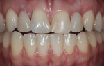 Figure 2 Interim partial denture teeth No. 7 and No. 10 modified for better esthetics.