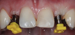 Figure 4 Impression of dental arch with implants 6 weeks after implant placement using closed-tray impression posts.