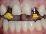 Figure 7 Final impression of implants after soft-tissue maturation 8 weeks following placement of the implant provisionals. Teeth No. 8 and No. 9 were prepared for labial ceramic veneers. The patient was not concerned about the difference in cervical length of the two central incisors and was not interested in having No. 9 cervically lengthened via a crown-lengthening procedure