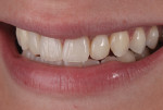 Figure 9 Esthetically pleasing final restorations seen in the patient’s smile. Note the low smile line.
