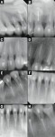 Figure 3  At the end of this acute phase, root canal therapy was performed on 15 of the 16 veneered teeth.