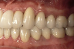Figure 18  Final restoration, including implant supported fixed partial denture across #7 through #10.