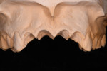 Figure 5 The master cast was modified by cutting off the teeth that will be extracted. The free gingival margin was outlined and maintained.