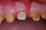 Figure 5 Tooth preparation for resin-veneered stainless steel crown.