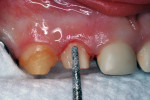 Figure 9 Diamond bur preparation of right lateral incisor.