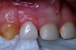 Figure 14 Zirconia crown fitted and cemented.