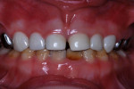 Figure 19 Central incisors 3 years postoperatively; lateral incisors and canine teeth, 18 months after treatment.