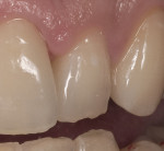 Figure 1  Preoperative condition in which tooth No. 10 is in slight lingual version and the patient desires a fuller contour.