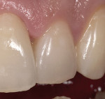 Figure 2  Postoperative view of a veneer which was fabricated with no preparation to alter contour.