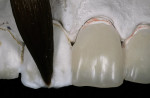 Figure 3  Building porcelain on a refractory cast using a duplicate provisional as a guide for contour. The preparation allows for 1 mm to 1.5mm of porcelain extension beyond the edge of the preparation.