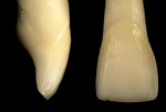 Figure 4  Facial and interproximal view of the facial window preparation in which the incisal edge is not covered.