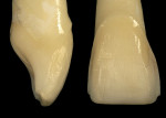 Figure 5  Facial and interproximal view of the incisal wrap preparation in which the preparation is carried to varying degrees over the incisal edge and finished on the lingual.