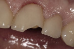 Figure 6  A case that failed clinically after 38 months. There was significant dentin exposure and lingual wrapping.