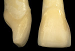 Figure 7  Facial and interproximal view of the incisal shoulder preparation. Note the rounded facial-incisal line angle.