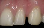 Figure 10  Prepared case in which the margin is placed more to the lingual to be able to contour the porcelain to close the diastema.