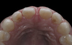 Figure 11  Incisal view showing the lingual position of the interproximal finish line for cases of closing diastemas or widening of the tooth.