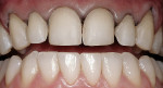 Figure 13b  Preparation of teeth Nos. 6 through 11. There was minimal enamel removal with a light chamfer placed circumferentially.
