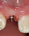 Figure 5  Placement of the ANEW™ implant.