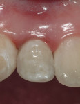 Figure 14  The final implant-supported restoration.