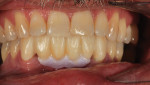 Fig 12. The application of GC Gradia Gum was taken chairside with the patient.