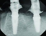 Periapical radiographs 3 weeks after grafting demonstrating initial organization of the NovaBone graft in the large osseous defect.